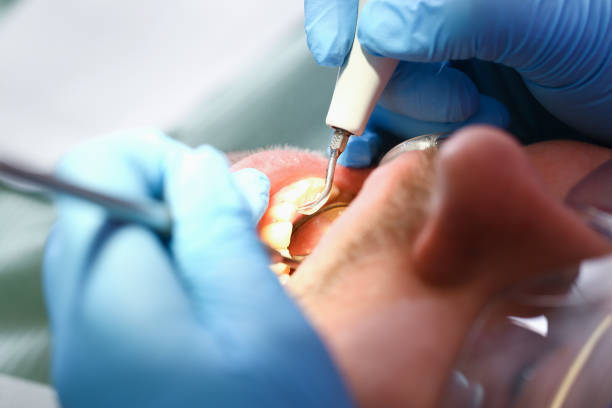 Best Knocked-Out Tooth (Avulsed Tooth) Treatment in Kalispell, MT